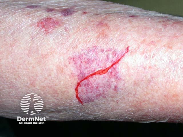 Skin fragility and bruising due to accelerated collagen loss is more common in postmenopausal women