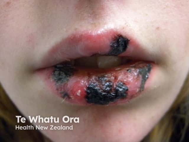 Mucosal ulceration