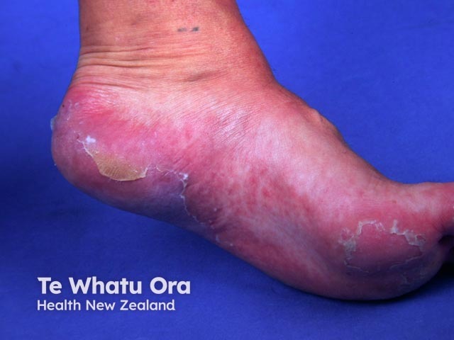 Systemic lupus erythematosus