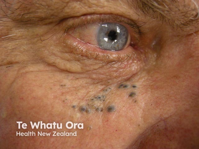 Solar comedones of the open type: the upper cheek is a typical site