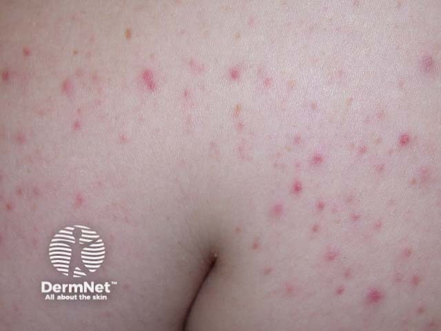 Steroid acne