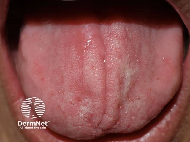 Stomatitis to contact with rubber glove during a dental procedure