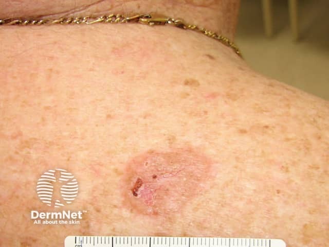 Superficial basal cell carcinoma, shoulder