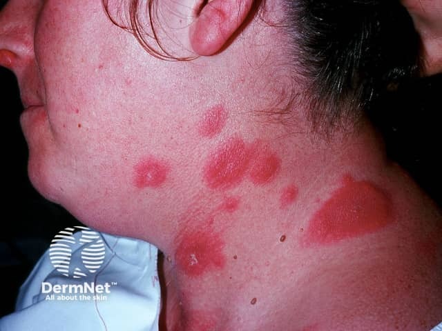 Plaques of tender acute febrile neutrophilic dermatosis on the neck