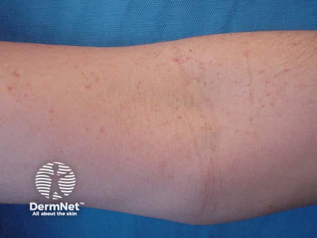 Spider telangiectases