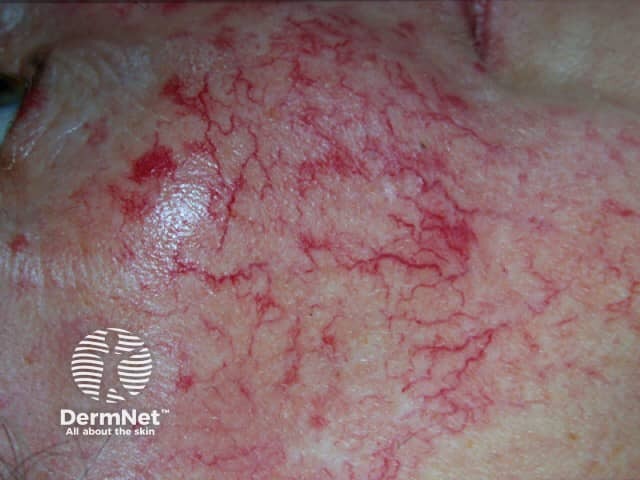 Familial telangiectasia