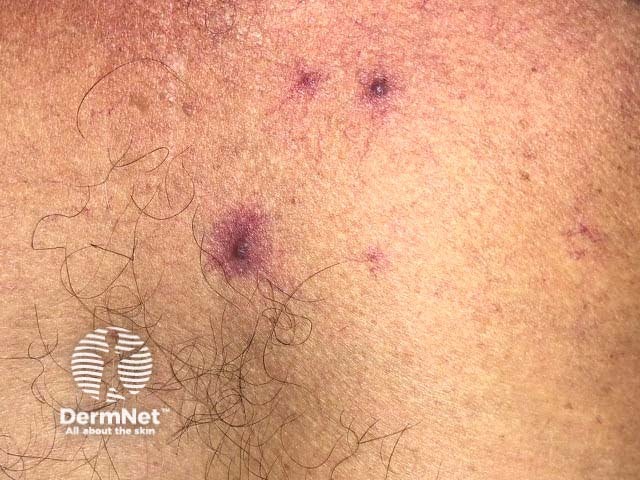 Telangiectases in patient with liver cirrhosis