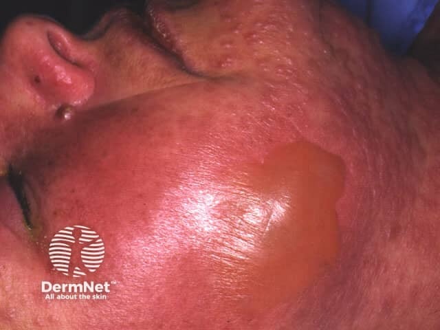 Sulfonamide-induced toxic epidermal necrolysis