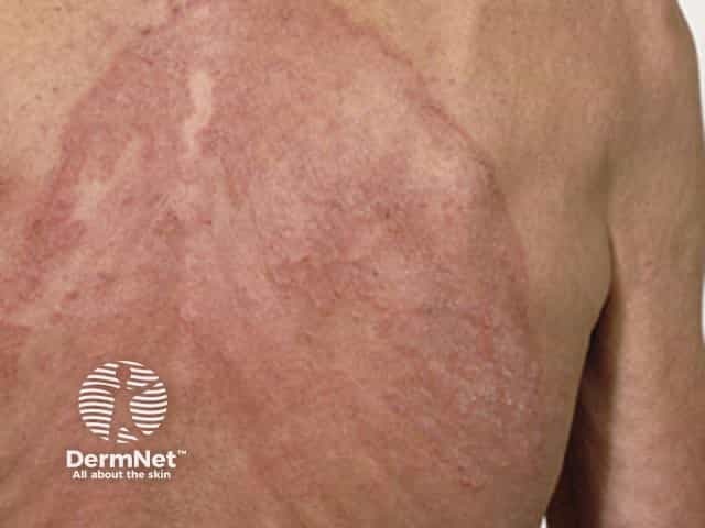 Extensive tinea corporis that has spread despite oral terbinafine should alert to antifungal resistance