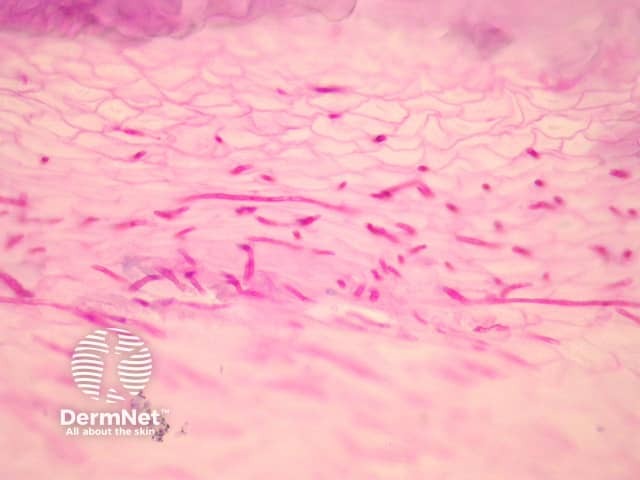 Onychomycosis pathology