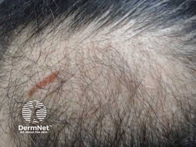 Clinical picture of a female patient with patchy hair loss in the temporal area.