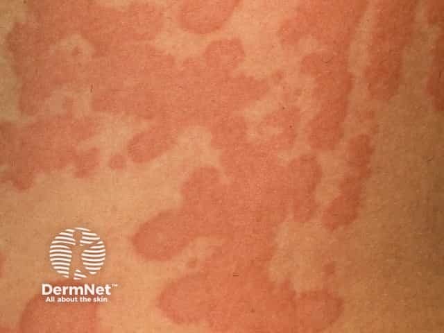 Urticaria