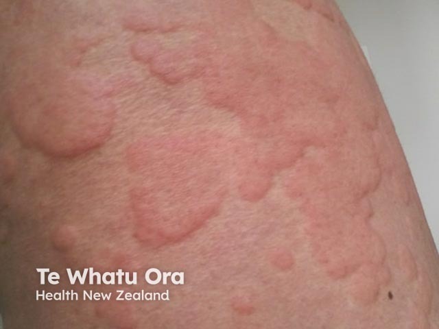 Severe acute urticaria during an anaphylactic attack