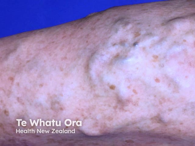 Varicosities and pigmentation