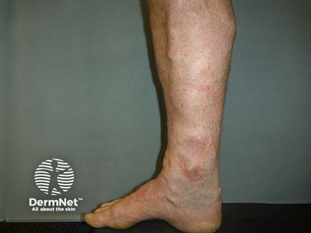 Varicosities and venous eczema