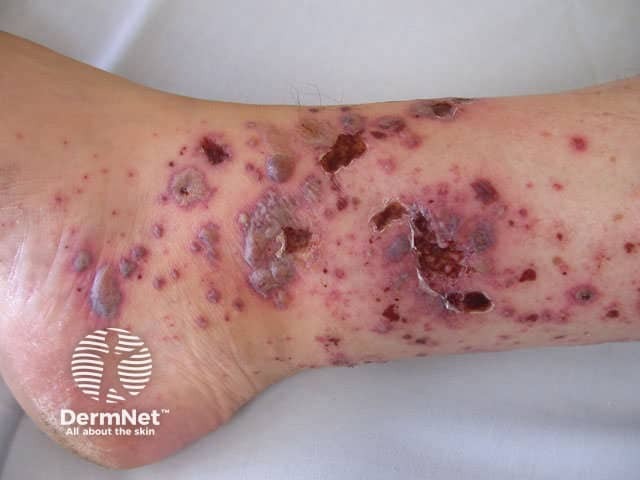 Henoch-Schönlein purpura