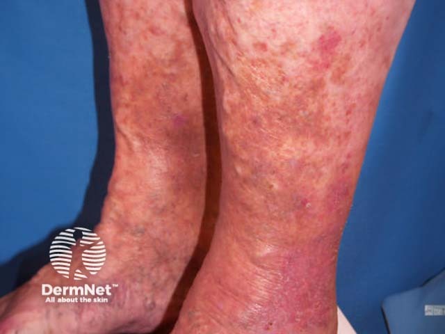 Patchy rusty-red pigmentation